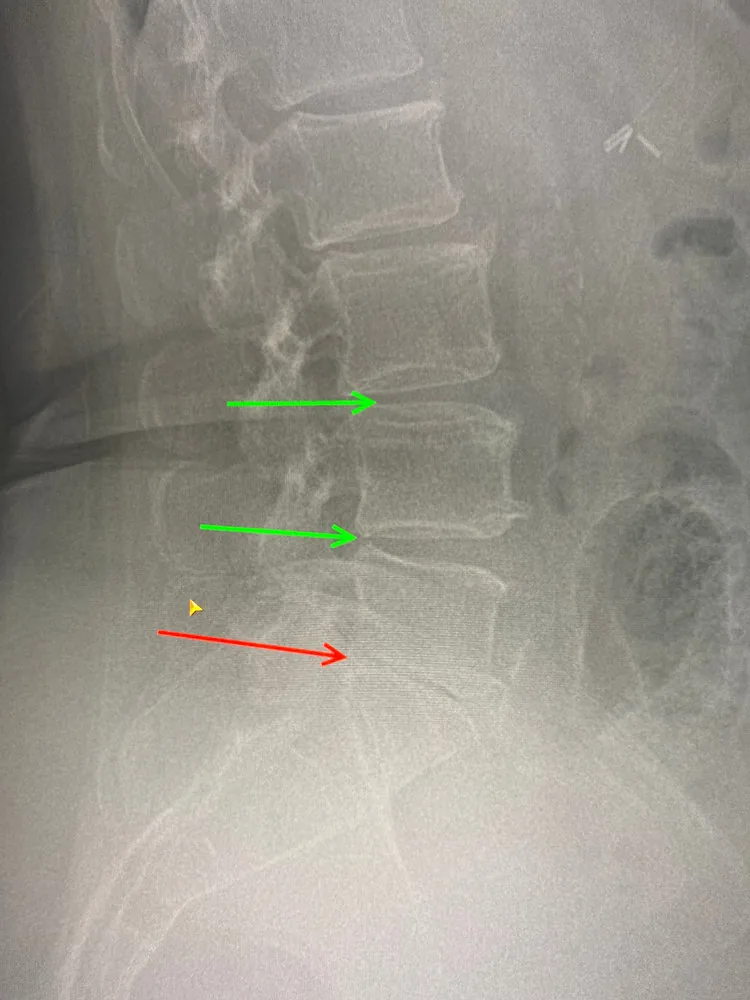 Severe Foot Drop Helped in Gray, ME.