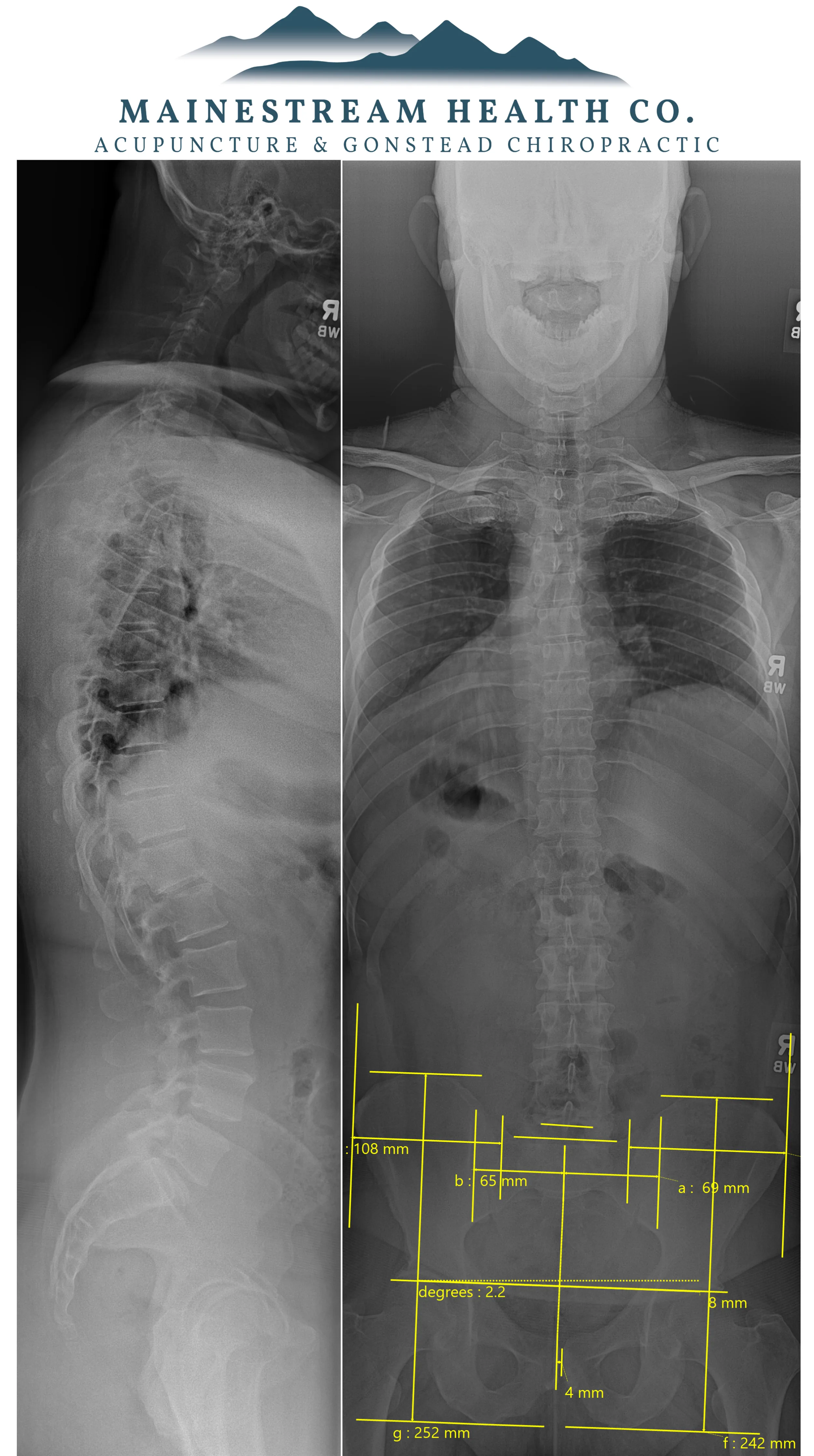 The Importance of X-rays in Chiropractic Care
