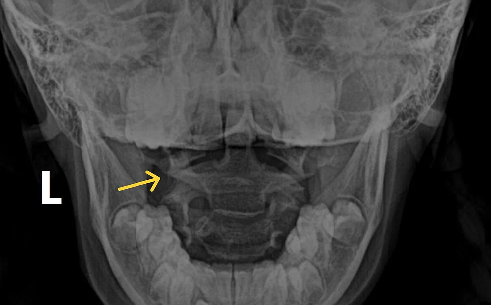Uncovering Hidden Cervical Spine Injuries in Pediatric Patients