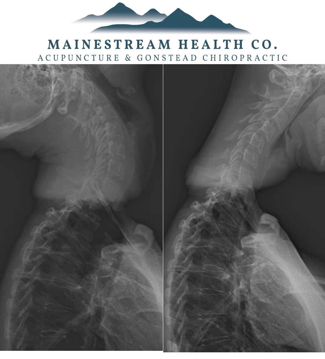 Flexion and extension x-ray views of the cervical and thoracic spine used in Gonstead headache analysis at Mainestream Health Co. in Gray, Maine.