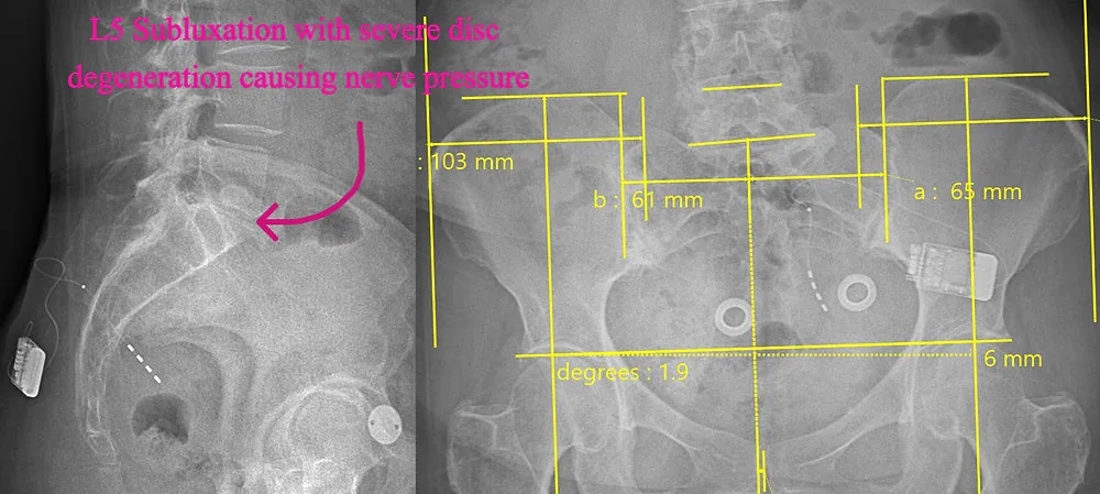 Bladder Control Problems Often Stem From Spine Problems